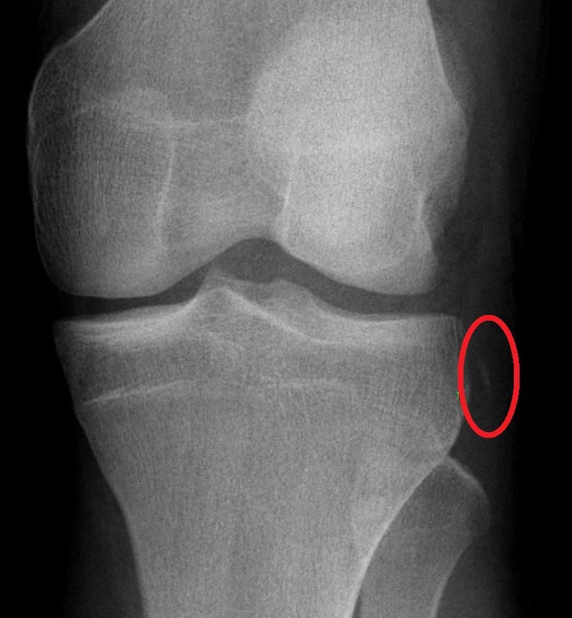 Segond fracture β lateral tibial plateau avulsion pathognomonic for ACL tear