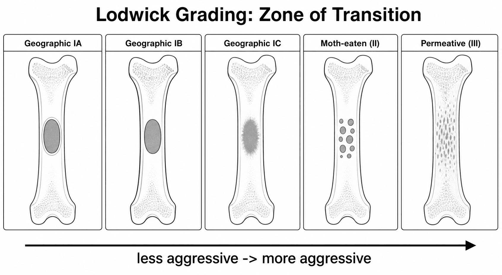 Diagram of Lodwick grading of bone-lesion margins from geographic with a sclerotic rim through moth-eaten to permeative.