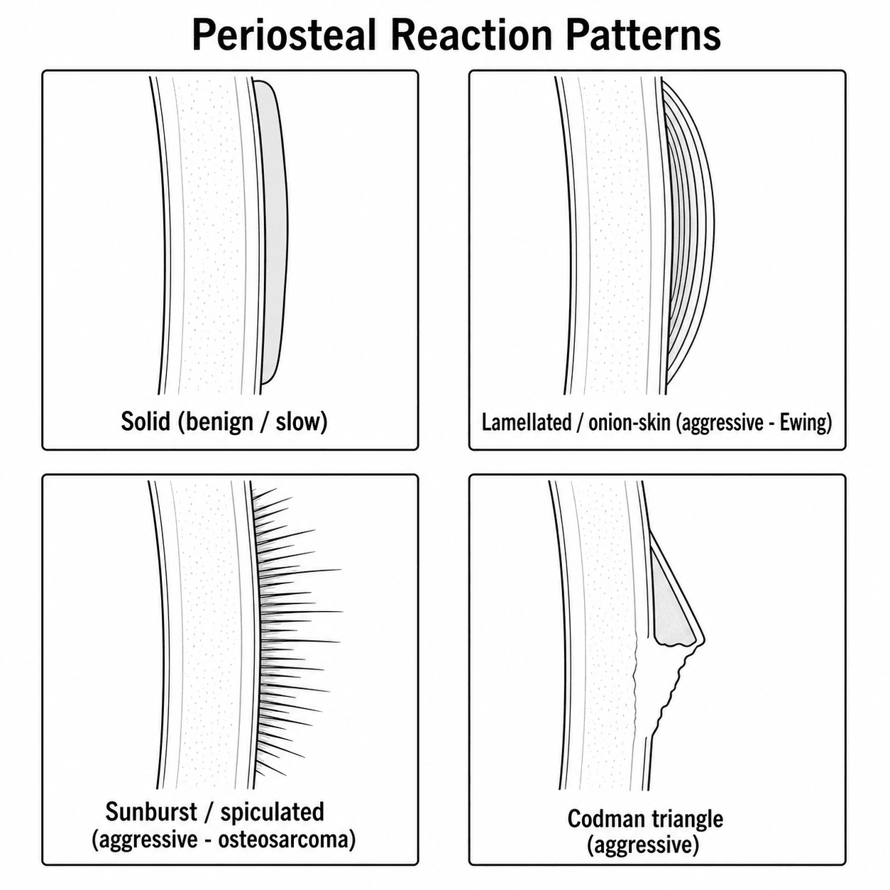 Diagram of periosteal reaction patterns: solid, lamellated onion-skin, sunburst spiculated, and Codman triangle.