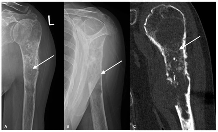 AP and lateral proximal humerus radiographs and CT showing a chondroid lesion with a wide transition zone, cortical breakthrough and periosteal reaction.