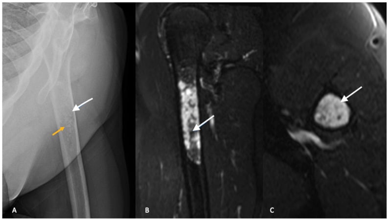 Radiograph and fat-suppressed T2 MRI of a proximal humeral chondroid lesion with stippled calcification and subtle endosteal scalloping but no cortical breakthrough.