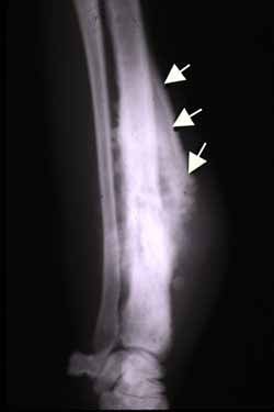 Codman triangle demonstrating lifted periosteum from aggressive bone tumour