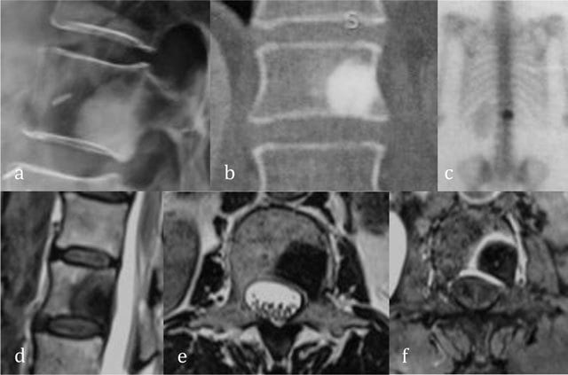 Radiograph, CT, bone scan and MRI of a vertebral enostosis showing cortical-density sclerosis and low MRI signal.