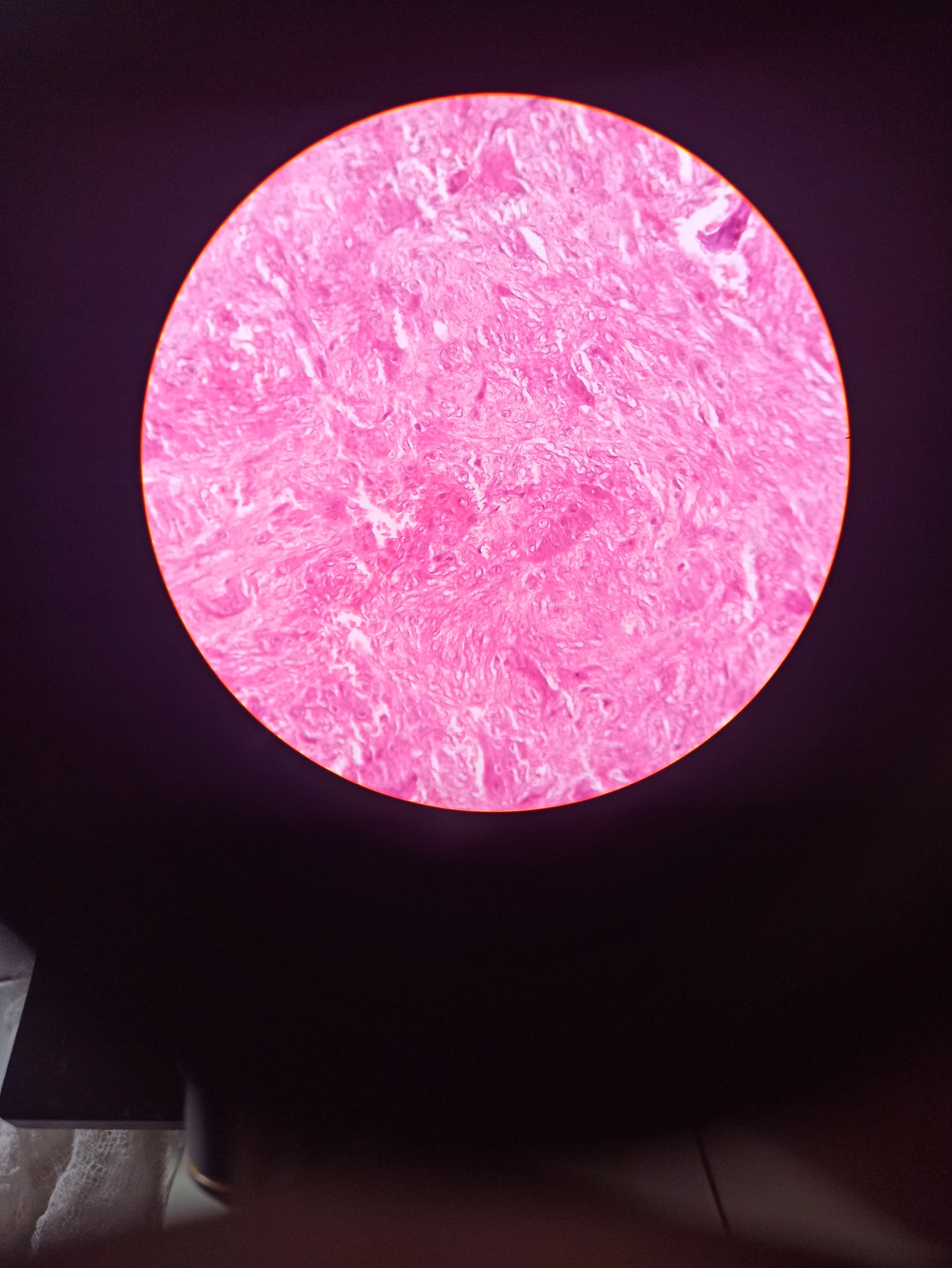 Giant cell tumour demonstrating subarticular lytic lesion
