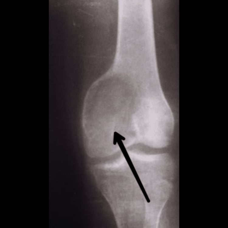 AP knee radiograph showing an eccentric subarticular lytic giant cell tumour of the medial femoral condyle.