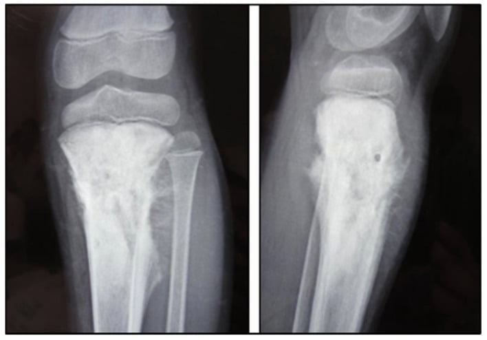 AP and lateral knee radiographs showing a sclerotic proximal tibial osteosarcoma with osteoid matrix, Codman triangle and sunburst periosteal reaction.