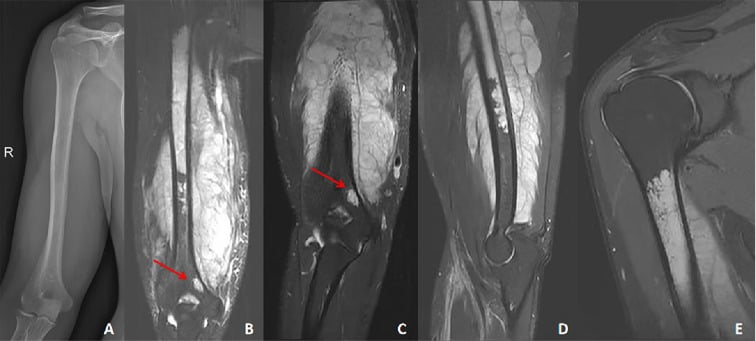 Radiograph and multiplanar MRI of a humeral osteosarcoma showing intramedullary and extraosseous tumour extent.