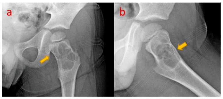 AP and frog-leg lateral left hip radiographs showing a simple bone cyst in the femoral neck with a pathological fracture.