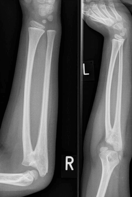 Forearm radiographs of a child showing the proximal radius and ulna fused by a bony bridge.