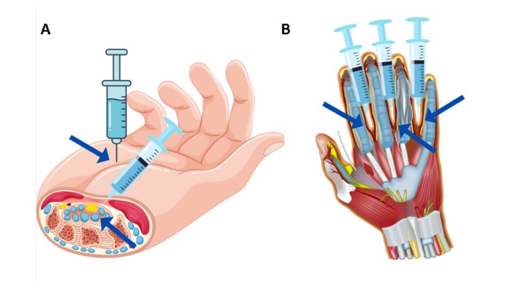 Diagram showing botulinum toxin injection in the distal palm and at the bases of the fingers