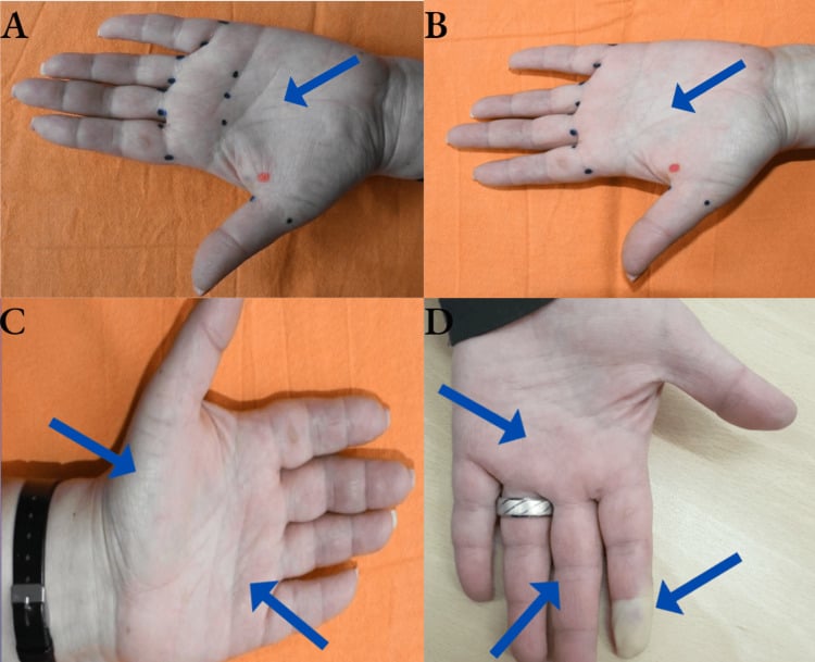 Serial hand photographs before and after botulinum toxin showing progressive return of palmar and digital colour