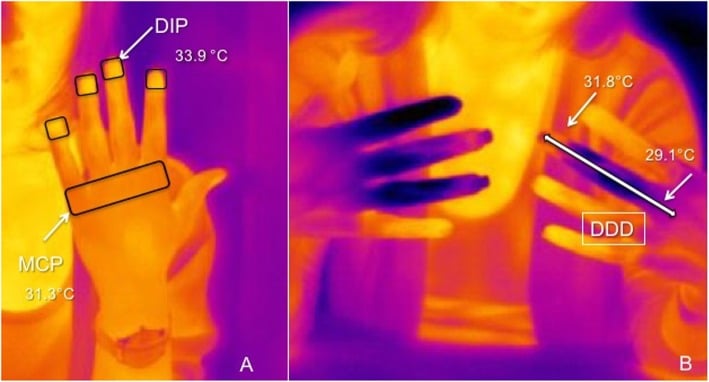 Infrared thermography showing hand temperatures and distal-dorsal temperature gradient during Raynaud assessment