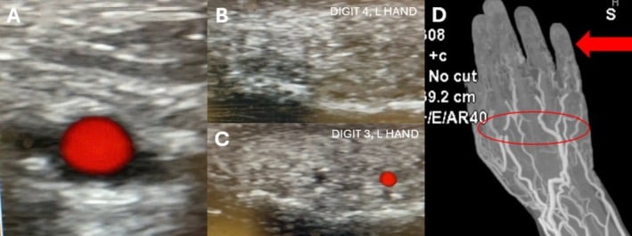 Colour Doppler ultrasound showing absent flow in one digit with CT angiography demonstrating an absent palmar arch