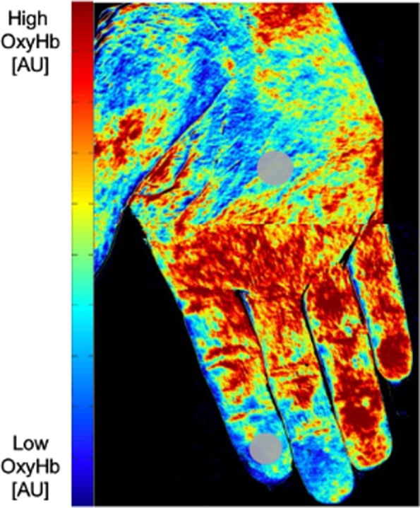 Hyperspectral oxyhaemoglobin map of a hand with systemic-sclerosis-associated Raynaud phenomenon