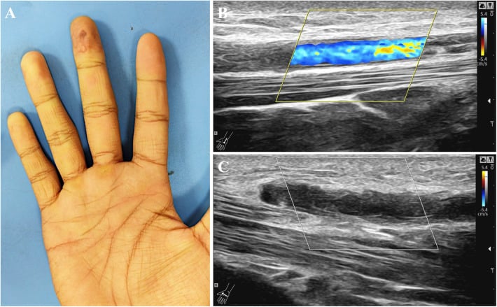 Hand with middle-finger ischaemia and hypothenar callus beside duplex ultrasound showing distal palmar arterial thrombosis