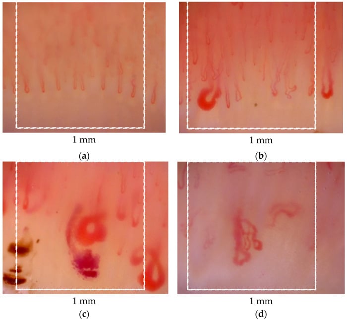 Nailfold videocapillaroscopy comparing normal, early, active and late systemic-sclerosis microangiopathy