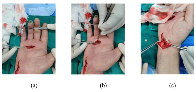 Microsurgical periarterial sympathectomy with adventitial stripping from digital vessels