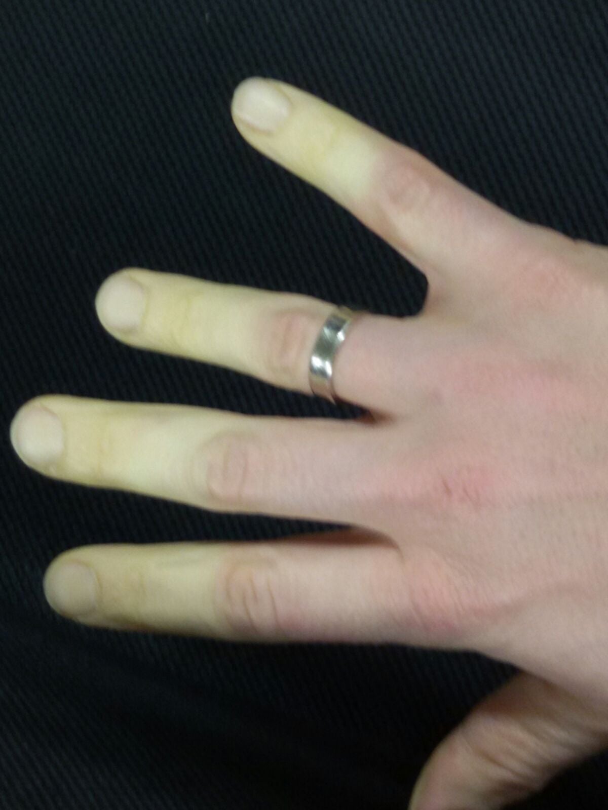 Clinical photograph of a hand with Raynaud's phenomenon showing pale, white, demarcated fingers