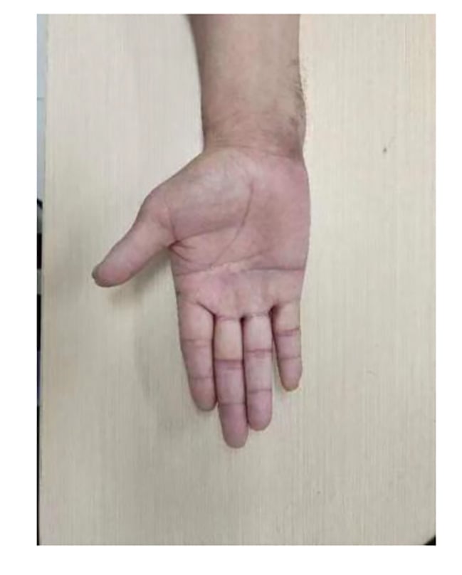 Postoperative hand after digital sympathectomy showing restored finger colour and perfusion