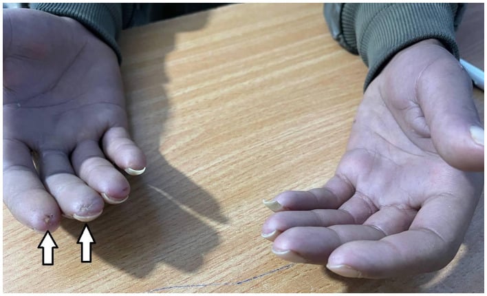 Systemic-sclerosis hands with dusky digits and necrotic fingertip ulcers