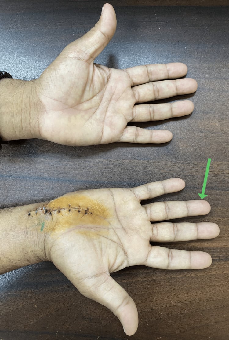 Two-week postoperative hand showing resolution of ring-finger colour change after ulnar artery reconstruction