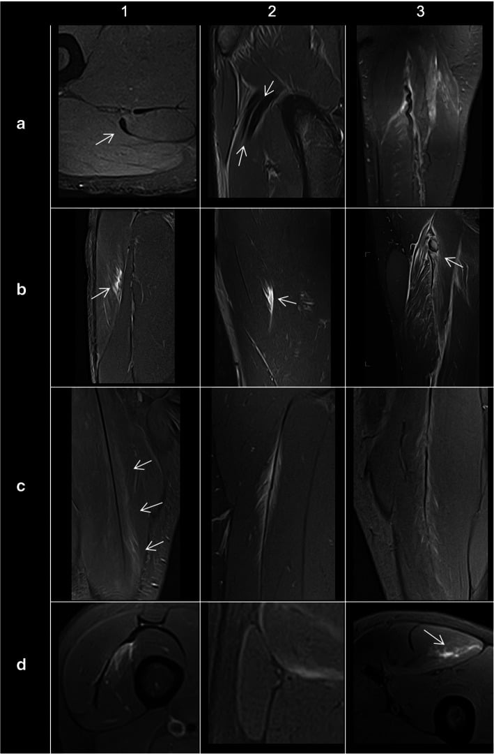 MRI framework distinguishing tendon, peripheral, central septal and isolated muscle-fibre injury patterns