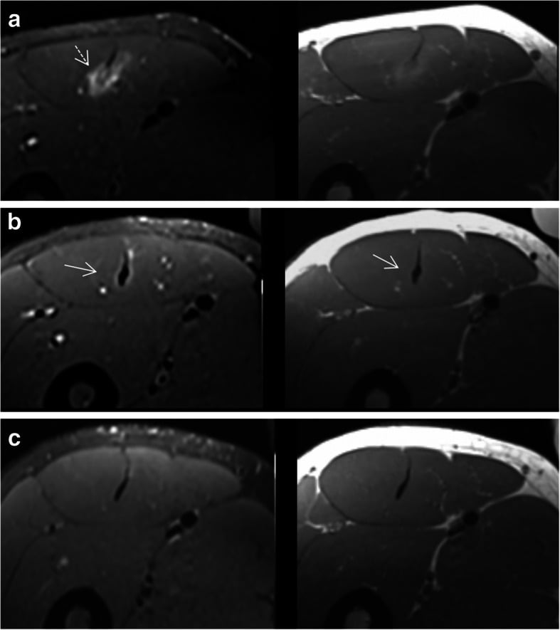 Serial MRI of rectus femoris central myoconnective healing at one to twelve weeks
