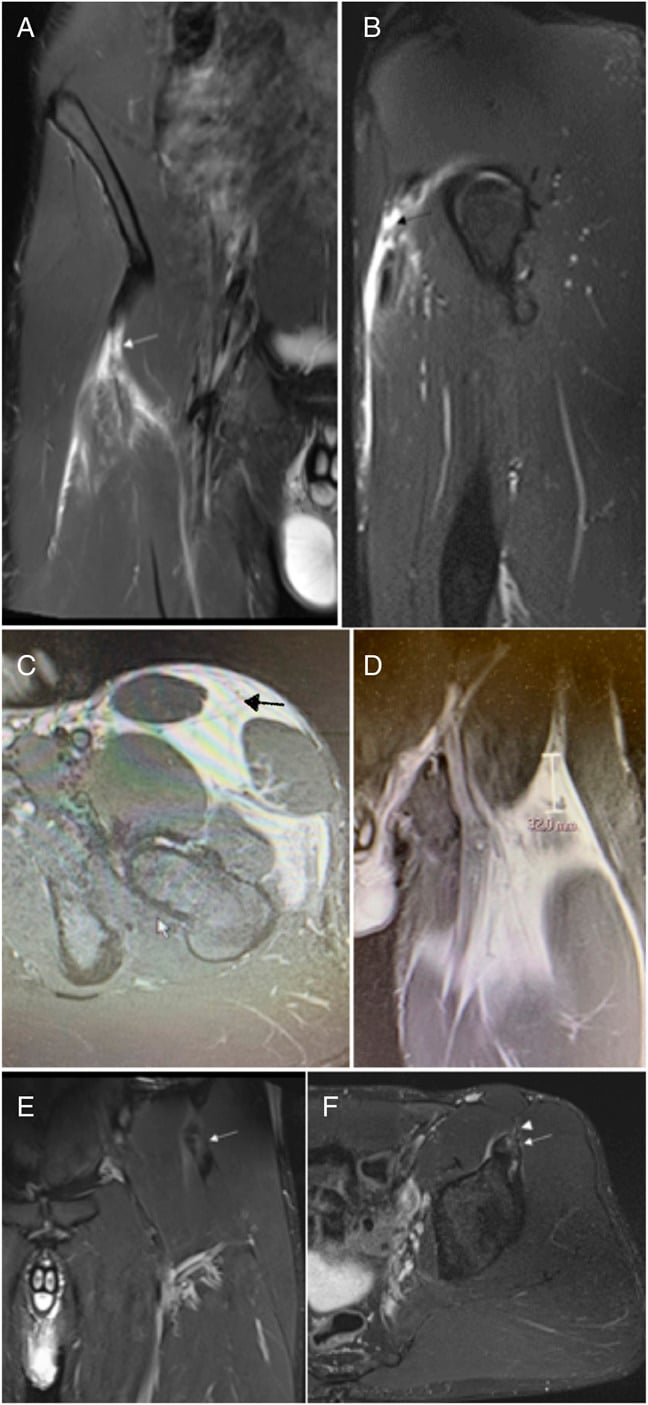 Multi-sequence MRI of a complete rectus femoris proximal tendon rupture with healing callus