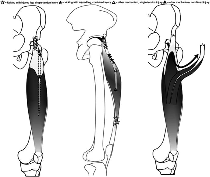Anatomical map relating rectus femoris injury level to kicking, sprinting and other mechanisms