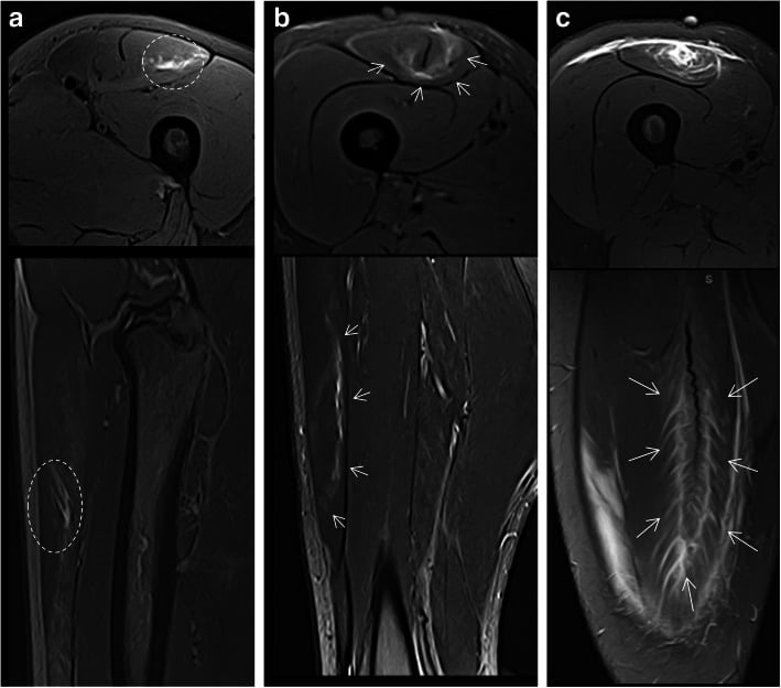 MRI progression of isolated intramuscular rectus femoris injuries around the central septum