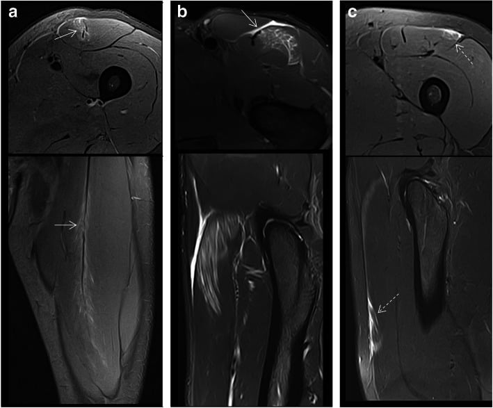 Fluid-sensitive MRI examples of central septal, aponeurotic and peripheral proximal rectus femoris injuries