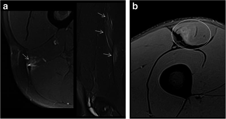 Fluid-sensitive MRI showing overload and adaptation signal beside healed lower-limb muscle scar