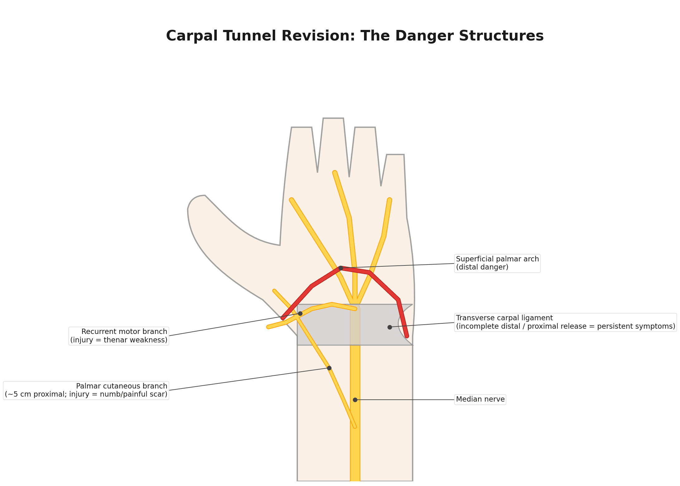 Palmar diagram of the carpal tunnel showing the transverse carpal ligament, median nerve, recurrent motor branch, palmar cutaneous branch and superficial palmar arch as the structures behind each mode of failure