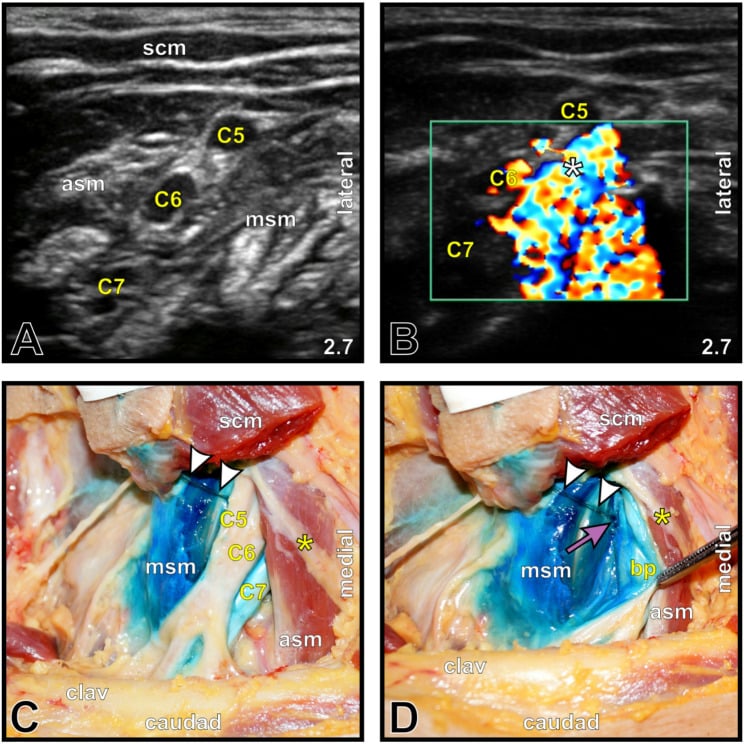 High-resolution B-mode ultrasound image of interscalene brachial plexus block