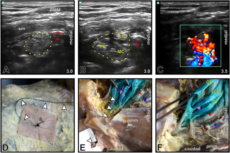 High-resolution B-mode ultrasound image of costoclavicular brachial plexus block