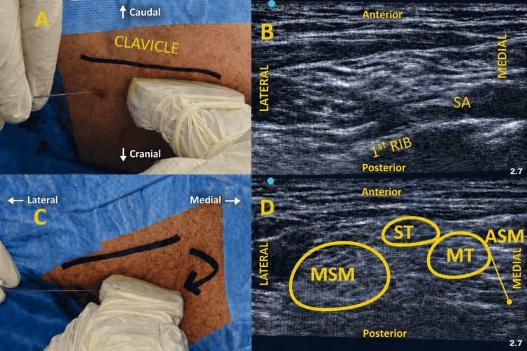 Ultrasound-guided selective trunk block scanning diagram