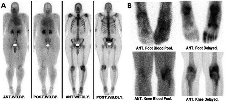 Whole-body and regional bone scintigraphy with focal uptake in the foot and knee.
