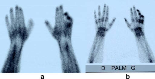 Early and delayed bone scintigraphy images showing staged uptake in the fourth and fifth fingers in CRPS.
