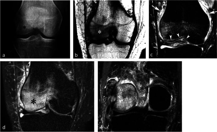 Knee radiograph and MRI showing focal bone loss with extensive marrow and soft-tissue oedema in complex regional pain syndrome.