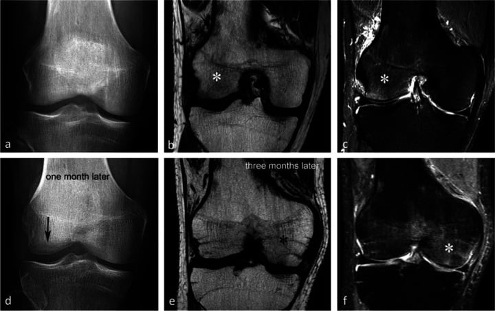 Serial knee radiographs and MRI showing migration of marrow oedema and later focal bone loss in CRPS.