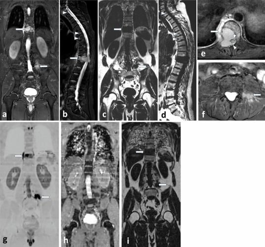 Whole-body MRI protocol images showing focal marrow lesions in multiple myeloma.