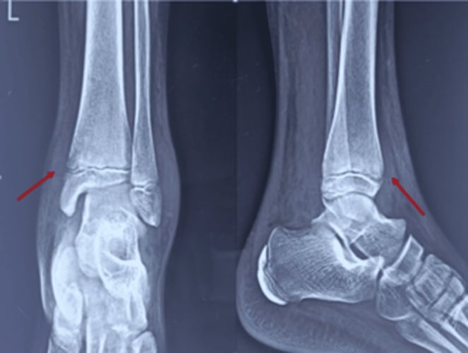 Ankle radiographs showing regional osteopenia, swelling and physeal irregularity from distal tibial osteomyelitis.