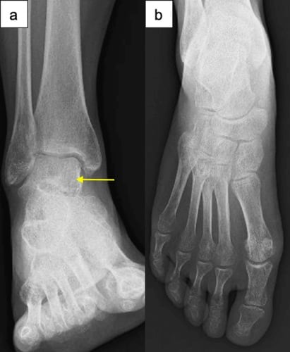 Follow-up ankle and foot radiographs showing partial recovery of regional bone density.