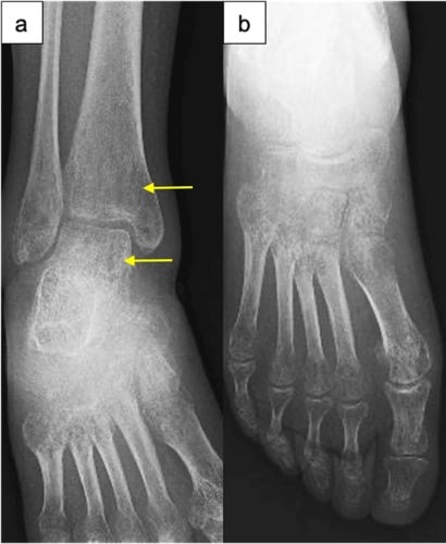 Anteroposterior ankle and foot radiographs showing diffuse osteopenia of the distal tibia, fibula and tarsal bones.