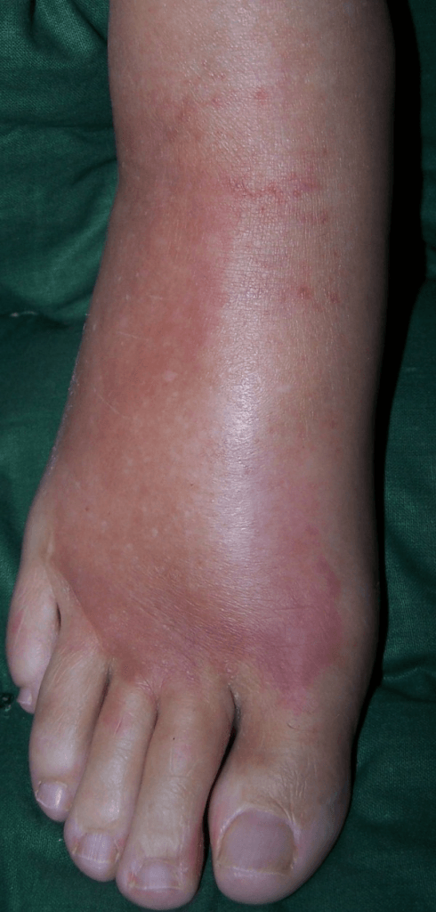 Photograph of a hot, swollen, erythematous right foot in complex regional pain syndrome.