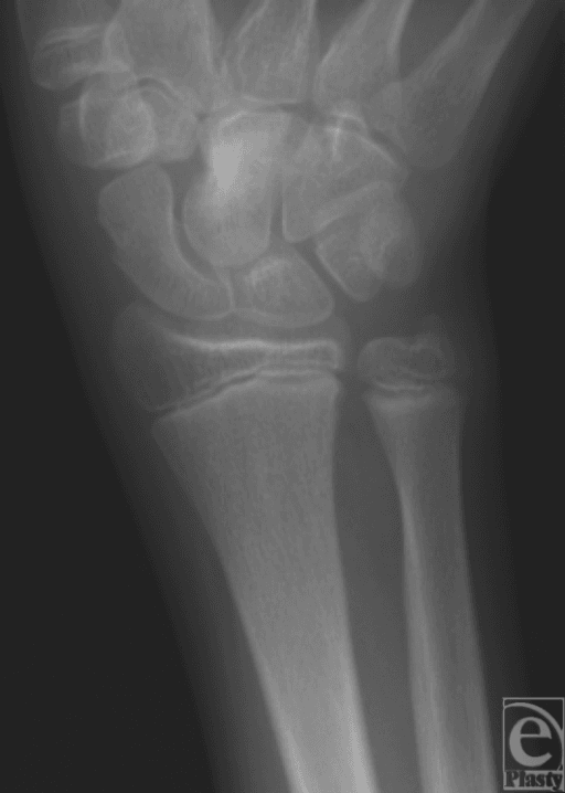 Plain radiograph of a left wrist.