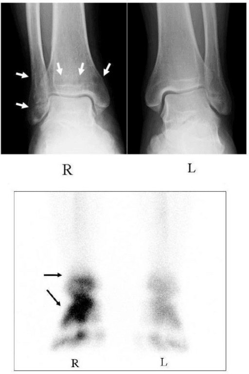 Paired ankle radiographs and bone scintigraphs showing regional osteoporotic change at the distal tibia and fibula.