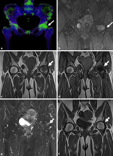Dual-energy CT and MRI showing reversible marrow oedema of the femoral head.