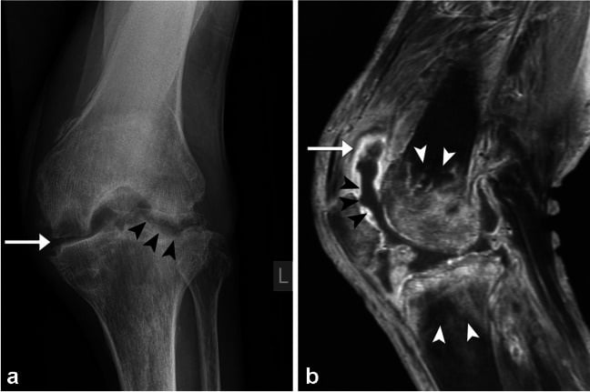 Knee radiograph and contrast-enhanced MRI showing septic arthritis with periarticular osteopenia and erosions.
