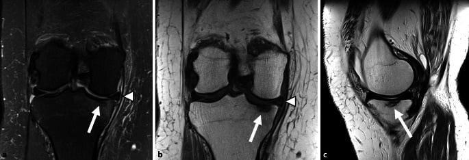 Multiplanar knee MRI showing marrow oedema, a subchondral fracture line and meniscal extrusion.
